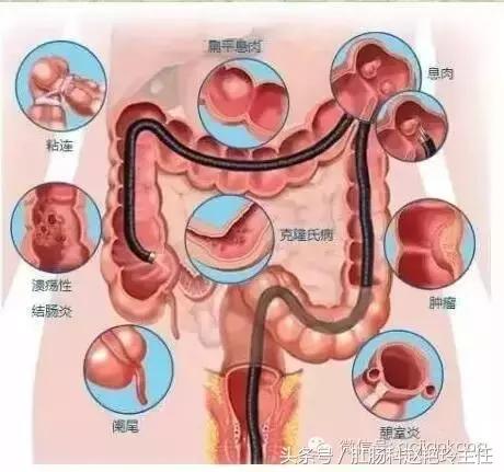 肠镜检查注意事项及肠道准备方法,肠镜检查注意事项科普