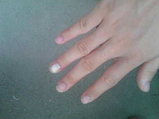 灰指甲会导致指甲变灰么,灰指甲指甲变颜色了怎么办