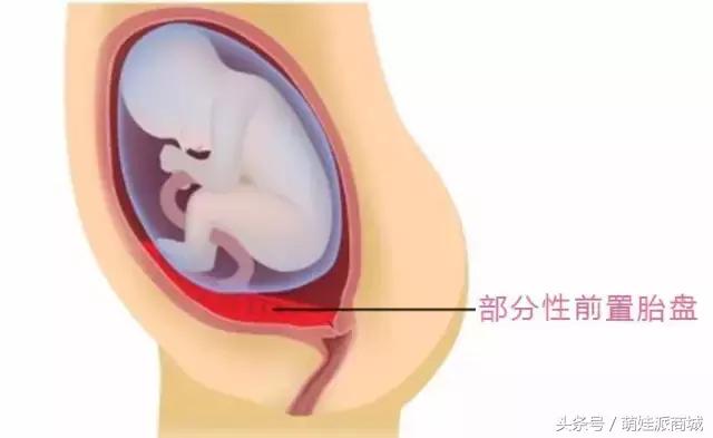 孕妇胎盘低怪谁,孕妇检查胎盘低是怎么回事