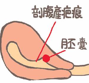 二胎如果怀在疤痕上有什么反应,二胎子宫疤痕薄能生三胎吗