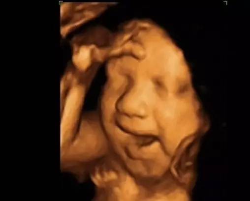 胎儿发育异常四维彩超能看出吗,四维彩超孕妈检查出畸形