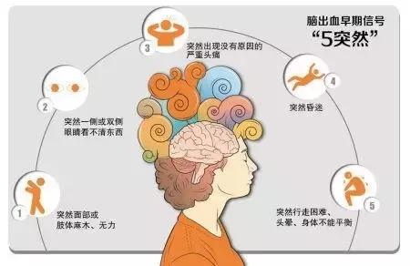 脑出血护理得当减少50%后遗症几率