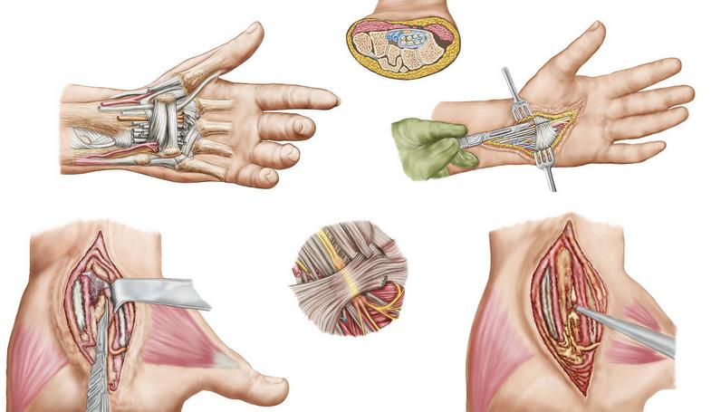 就医搜｜腕管综合征：容易在键盘上“敲”出的疾病！