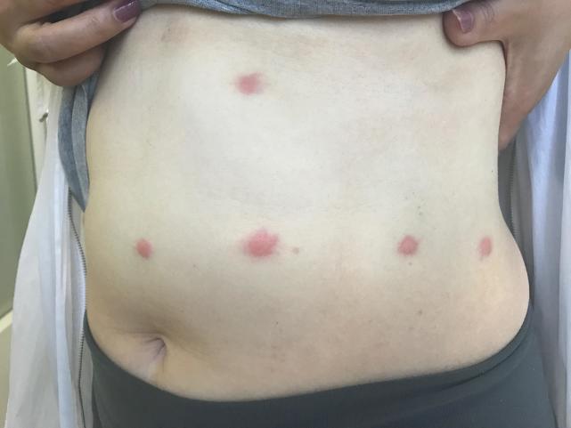 被蚊虫咬了很多红包特别痒，到底要不要忌口？