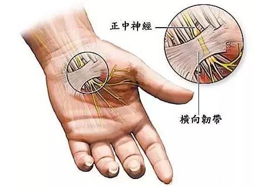 就医搜｜腕管综合征：容易在键盘上“敲”出的疾病！