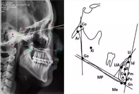 正畸最常用的头影测量法,口腔正畸学入门必学之头影测量