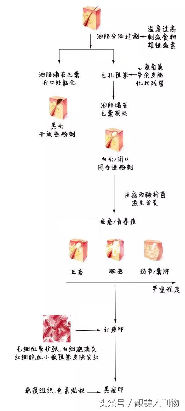 有很多痘印痘坑如何快速消除,常见的痘印类型和祛除痘印的方法