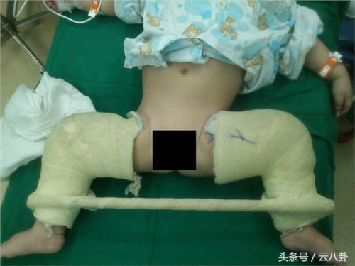小孩双腿关节不对称,幼儿腿关节有响声挂什么科