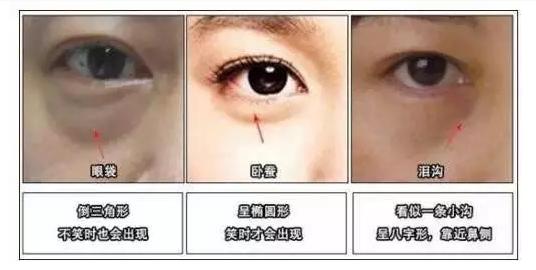 切除眼袋是唯一解决眼袋的方法,眼袋切除方法有哪些