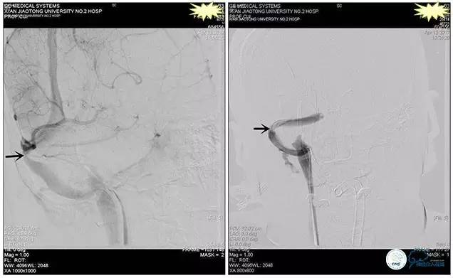 静脉窦狭窄支架植入术,静脉窦狭窄做支架多少钱