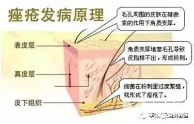 青春痘也叫痤疮,疮疖和青春痘有区别吗