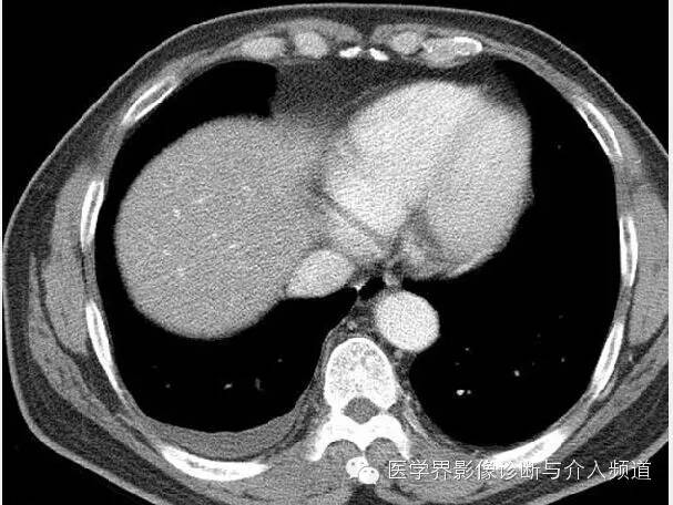 咳嗽排除了肺部的问题,咳嗽为什么比不咳好