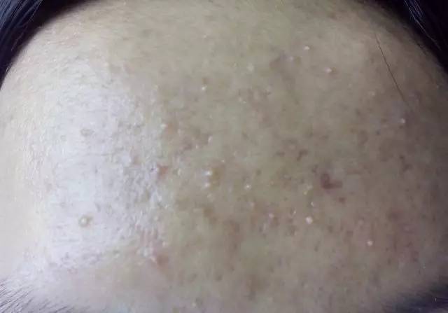 战痘合集完整版,战痘大结局完整版