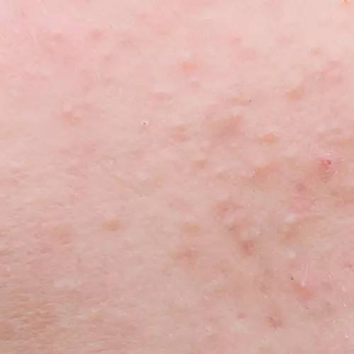 战痘｜史上最全”战痘“解答50+合集！