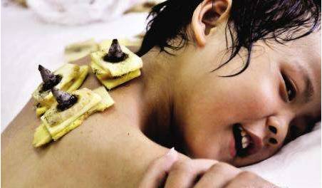 三伏贴能自制吗?孩子能贴吗?选择哪些穴位贴?贵医附院专家为你详细解答