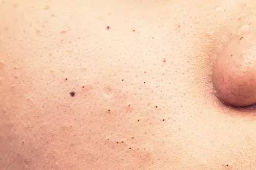 战痘｜史上最全”战痘“解答50+合集！