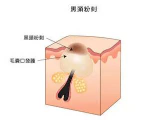 战痘大结局完整版,战痘合集完整版