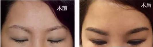 严重脱发秃顶发际线后移如何改善,长期熬夜导致发际线后移秃顶脱发