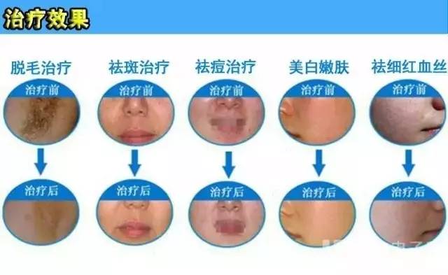 祛痘印用什么激光祛痘好,激光祛痘印痘坑能彻底去掉痘痘吗