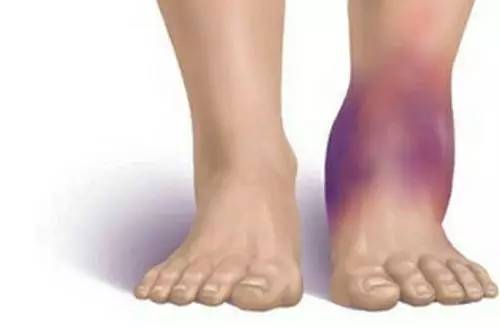 天气凉注意保护膝盖,冬天脚踝保护方法