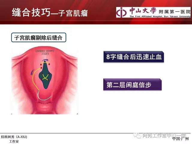 妇科腹腔镜下常用缝合技巧