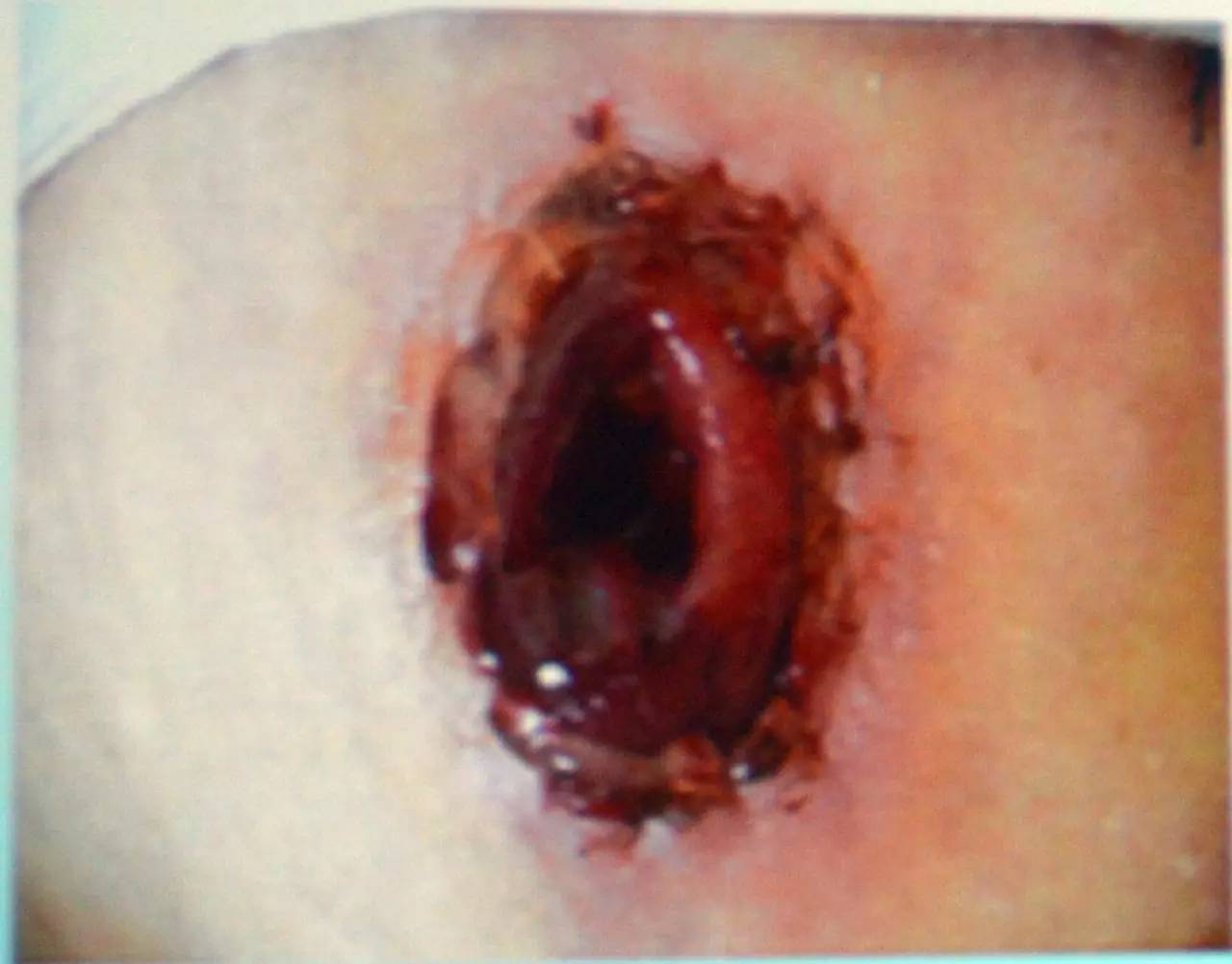 肠造口常见周围皮肤并发症,肠造口护理操作并发症