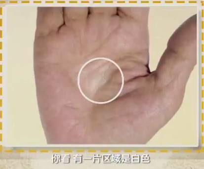 手上发红发紫是怎么回事,手部发青要警惕