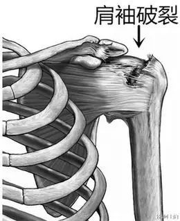 吓人！她肩膀居然破了个“洞”，只因天天做这个动作……黔南人赶紧自查看看！