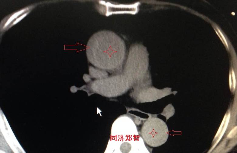急性主动脉夹层cta影像诊断与鉴别,冠状动脉cta可以看到主动脉夹层吗