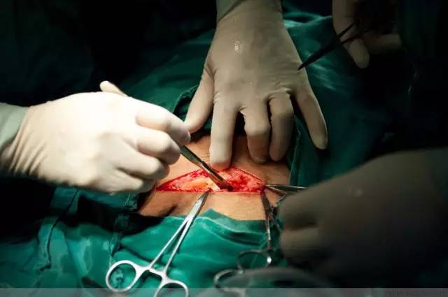 剖腹产全景记录,剖腹产恢复不同时期的照片