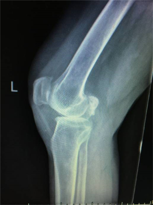 湘雅医院膝关节置换手术案例,赣州膝关节置换手术