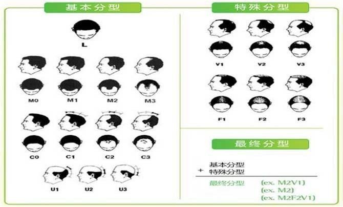 科普｜雄激素性脱发的病因及治疗