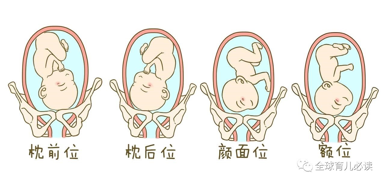 胎位不正婆婆让顺产,顺产胎位不正压肚子