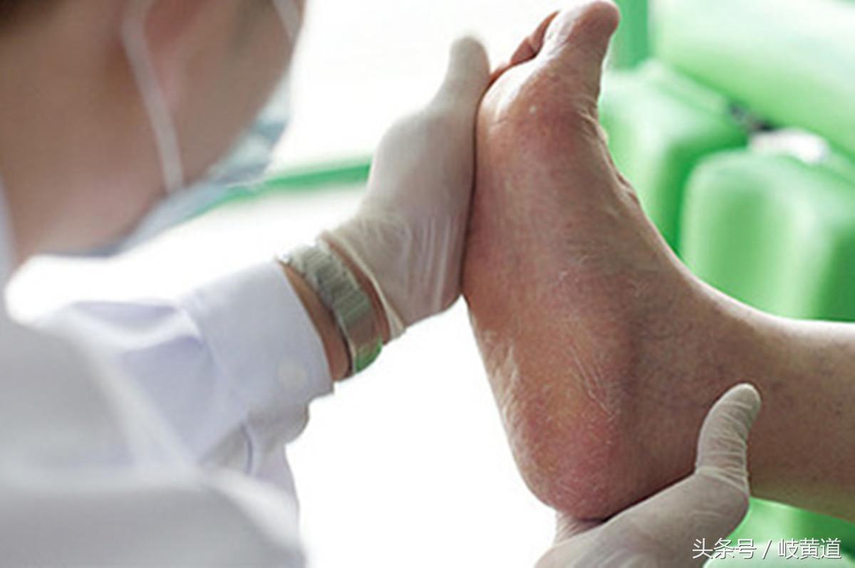 鸡眼总是不好怎么办,中医鸡眼是怎么回事