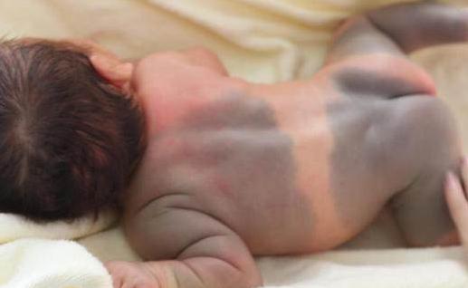 胎宝宝身上很多胎记是什么原因,孕妈以下行为会导致宝宝长胎记