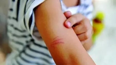 给孩子养猫怕被抓伤剪指甲,小孩被小猫咪抓伤了用打疫苗吗