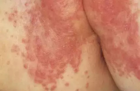 宝宝红屁股跟妈妈心情有关吗,宝宝红屁股怎么缓解疼痛