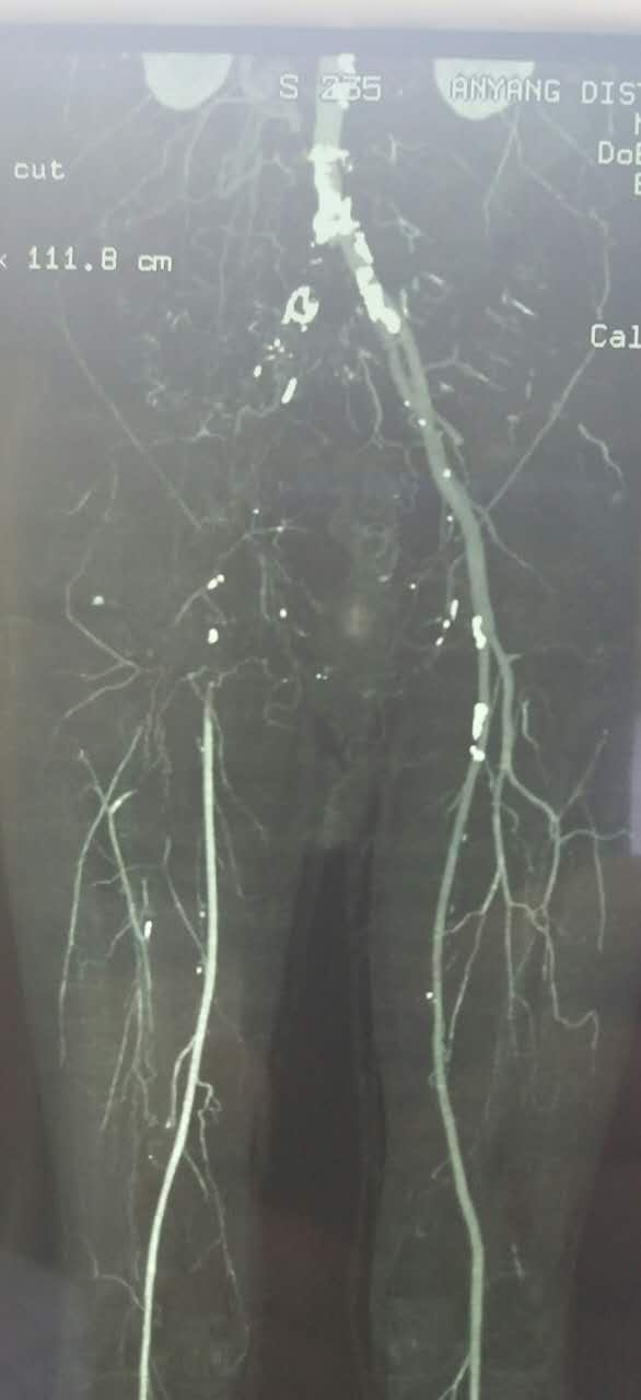 治下肢血栓闭塞脉管炎中药方,下肢动脉慢性血栓闭塞