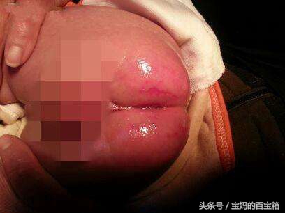 宝宝尿布疹总是反复发作怎么办,宝宝尿布疹红得厉害怎么办