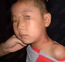 脐周肠系膜淋巴结肿大用药,肠系膜淋巴结肿大饮食怎么吃