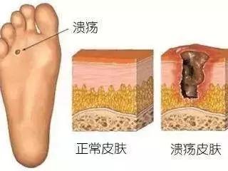 新鞋磨脚脚踝贴用法,新鞋磨脚后跟处用创可贴