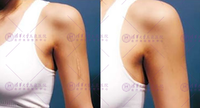 激光夏天做还是冬天做比较好,激光夏天做好还是冬天做好