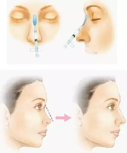 鼻子不好看的女性,线雕鼻做好鼻梁太细是什么原因