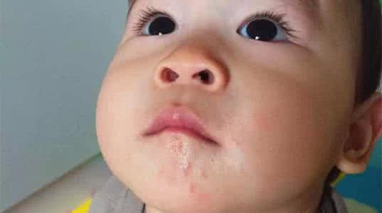 预防宝宝口水疹抹什么药膏好,口水疹是每个孩子都起吗
