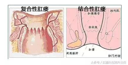 肛瘘怎么治疗好？专业医生也在看的肛瘘治疗指南