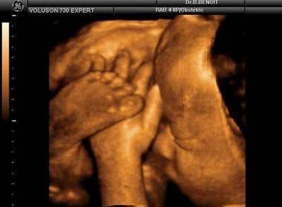 四维彩超宝宝不配合宝爸怎么做,做四维胎宝宝不配合说明什么