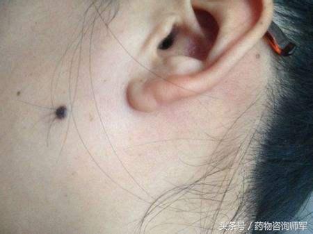 奴仆宫有痣如何分辨善恶,怎么看善恶痣