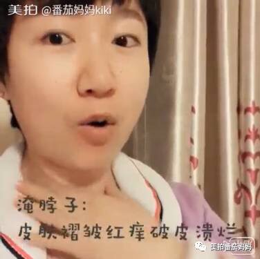 婴儿淹脖子发红怎么处理,宝宝淹脖子和红屁屁用什么产品