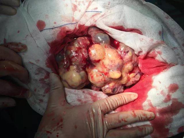 绝经期发现卵巢囊肿要紧吗,卵巢癌会引起绝经后乳房胀吗