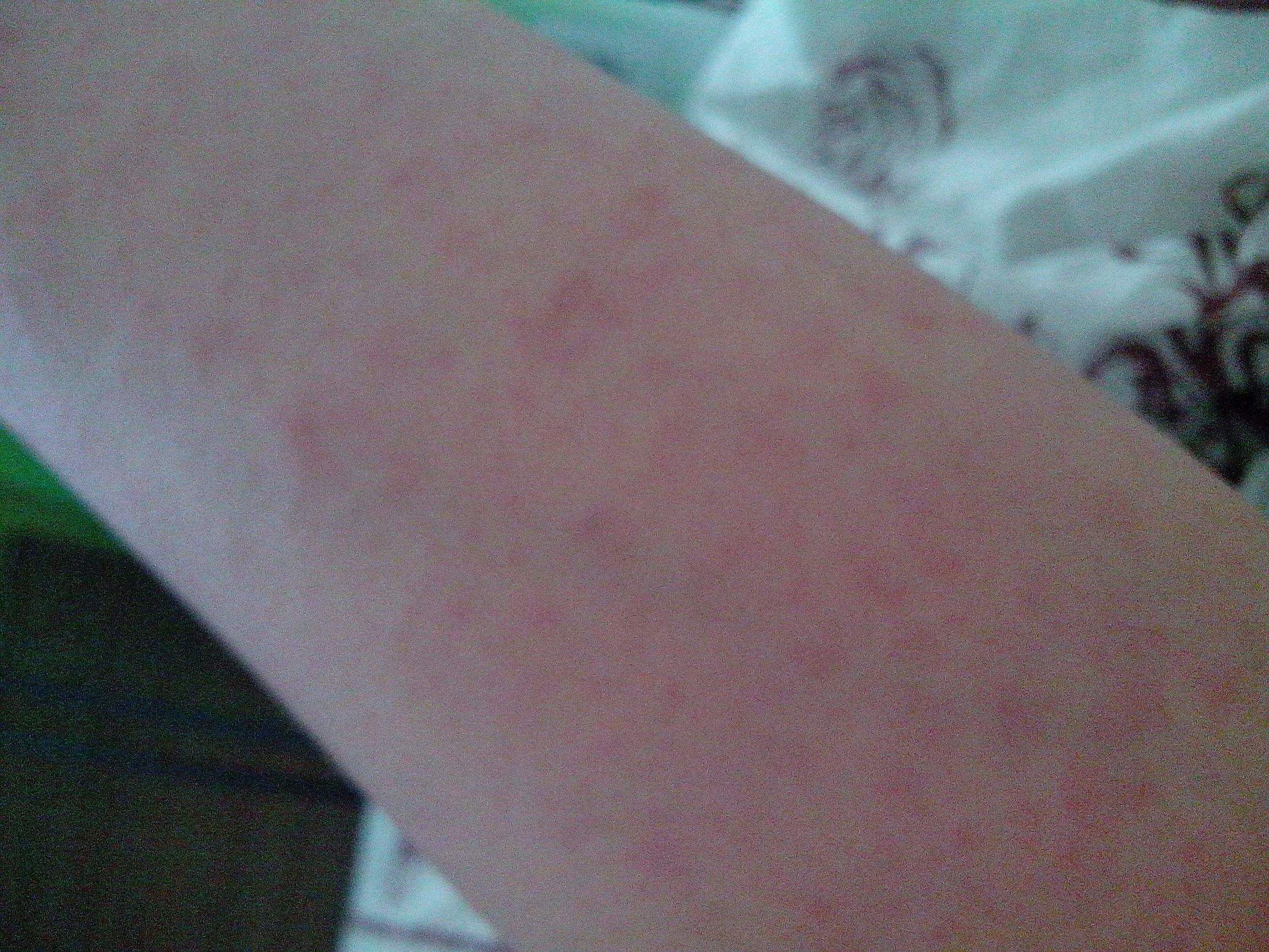 皮肤长小红痣不痛不痒是什么原因,身上长了好多小红痣是什么症状